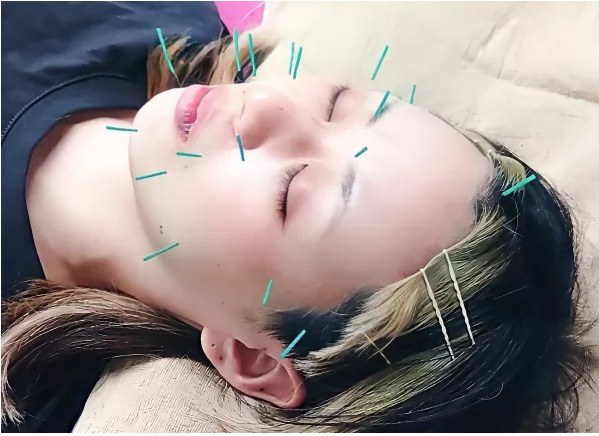 美容鍼灸で小顔 リフトアップ 三軒茶屋で人気のおすすめ鍼灸院4選 マチしる東京