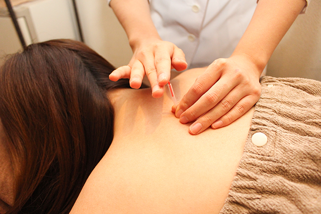 初めての方におすすめ 銀座駅近くで評判の鍼灸院 カッピング3選 マチしる東京